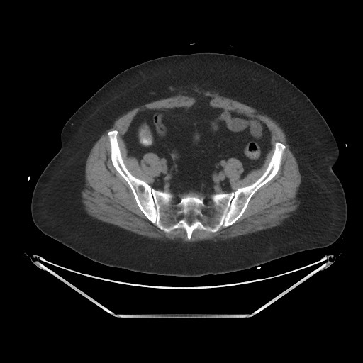 File:Acute cholecystitis with tensile fundus sign (Radiopaedia 71394-81723 Axial non-contrast 90).jpg