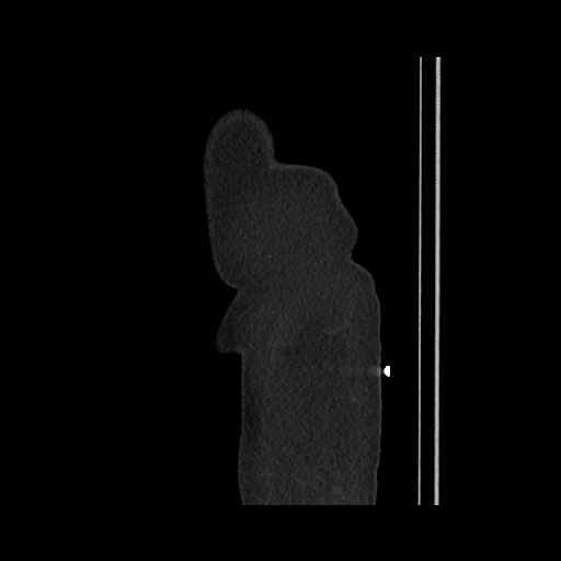 Acute cholecystitis with tensile fundus sign (Radiopaedia 71394-81723 Sagittal non-contrast 17).jpg