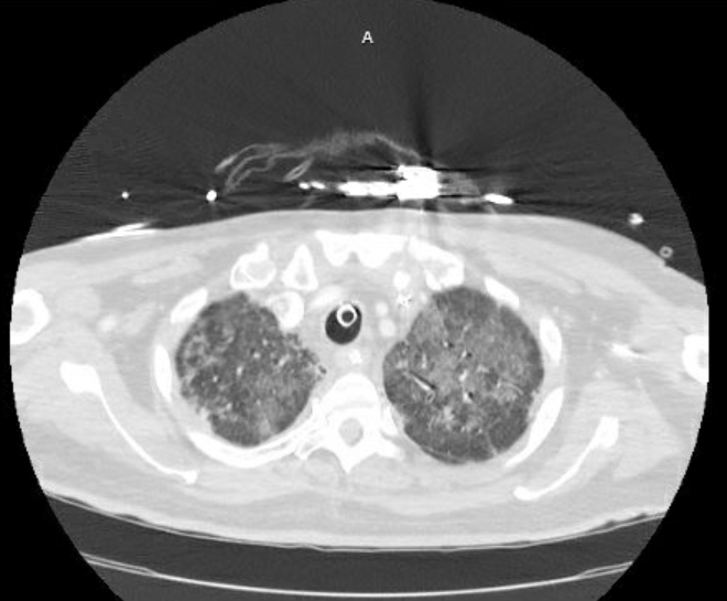 Acute cor pulmonale (ultrasound) (Radiopaedia 83508-98818 Axial lung window 19).jpg