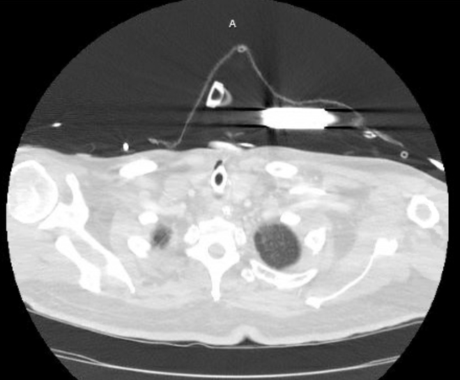 Acute cor pulmonale (ultrasound) (Radiopaedia 83508-98818 Axial lung window 4).jpg