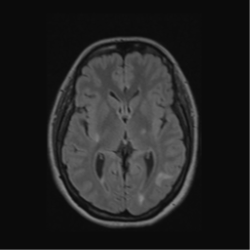 Acute disseminated encephalomyelitis (ADEM) (Radiopaedia 38073-40065 Axial FLAIR 31).png