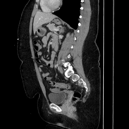Acute diverticulitis - transverse colon (Radiopaedia 87063-103327 Sagittal C+ portal venous phase 135).jpg