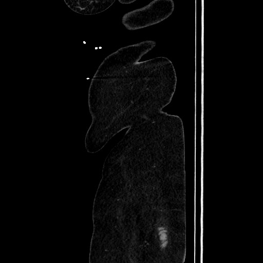 Acute diverticulitis - transverse colon (Radiopaedia 87063-103327 Sagittal C+ portal venous phase 214).jpg