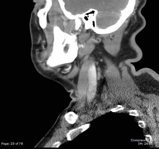 Acute epiglottitis (Radiopaedia 54375-60590 Sagittal C+ arterial phase 25).jpg