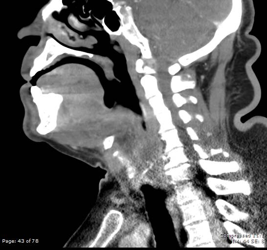 Acute epiglottitis (Radiopaedia 54375-60590 Sagittal C+ arterial phase 43).jpg