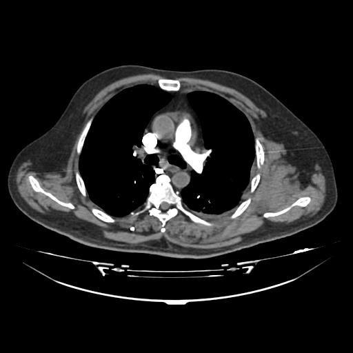 File:Acute heart failure (CT) (Radiopaedia 79835-93075 Axial C+ arterial phase 3).jpg