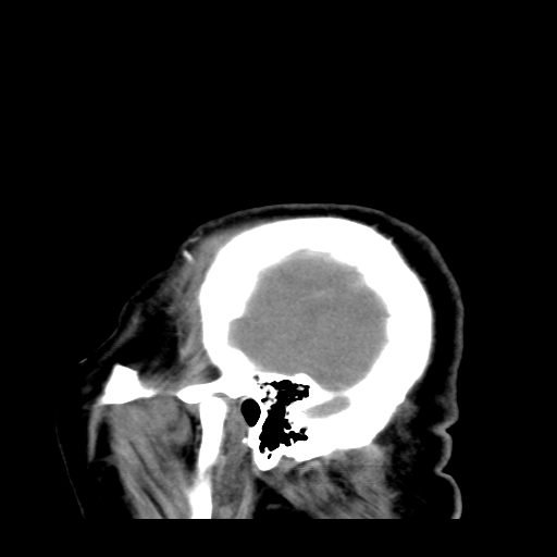 File:Acute hemorrhagic stroke (Radiopaedia 17507-17223 Sagittal non-contrast 4).jpg