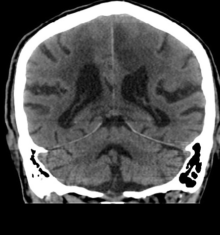 File:Acute left anterior cerebral artery territory infarction (Radiopaedia 51785-57578 Coronal non-contrast 40).jpg