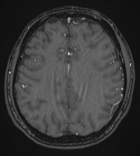 Acute left middle cerebral artery territory infarct with clot retrieval (Radiopaedia 47732-52433 Axial MRA 46).png