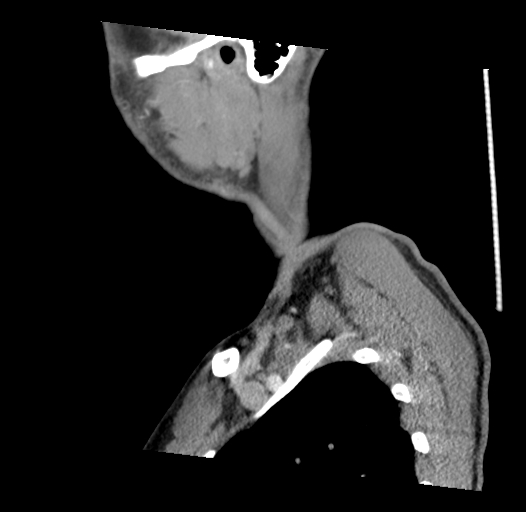 Acute longus colli calcific tendinitis (Radiopaedia 72495-83036 Sagittal C+ arterial phase 3).jpg