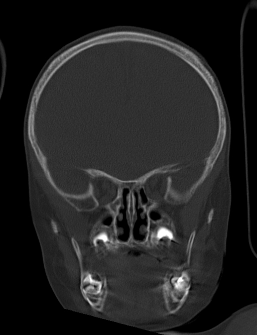 Acute mastoiditis (Radiopaedia 82678-96881 Coronal bone window 23).jpg