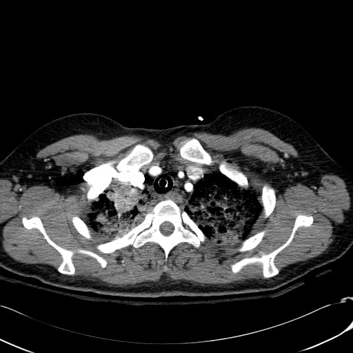 Acute myocardial infarction in CT (Radiopaedia 39947-42415 Axial C+ arterial phase 21).jpg