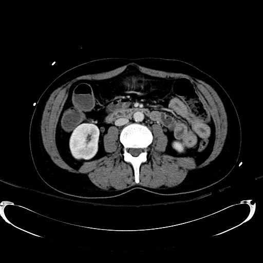 Acute myocardial infarction in CT (Radiopaedia 39947-42415 Axial C+ portal venous phase 65).jpg