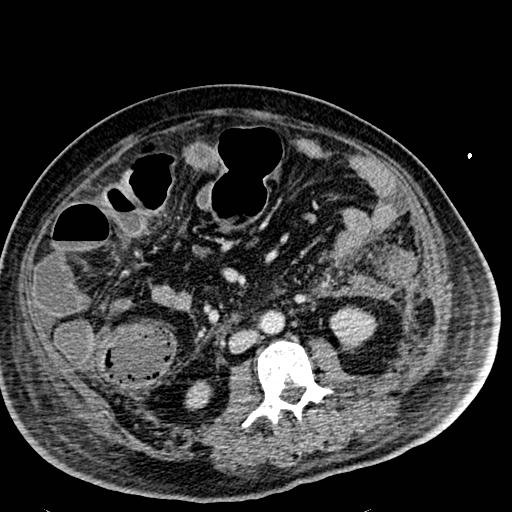 Acute pancreatic necrosis (Radiopaedia 13560-18501 Axial C+ portal venous phase 77).jpg