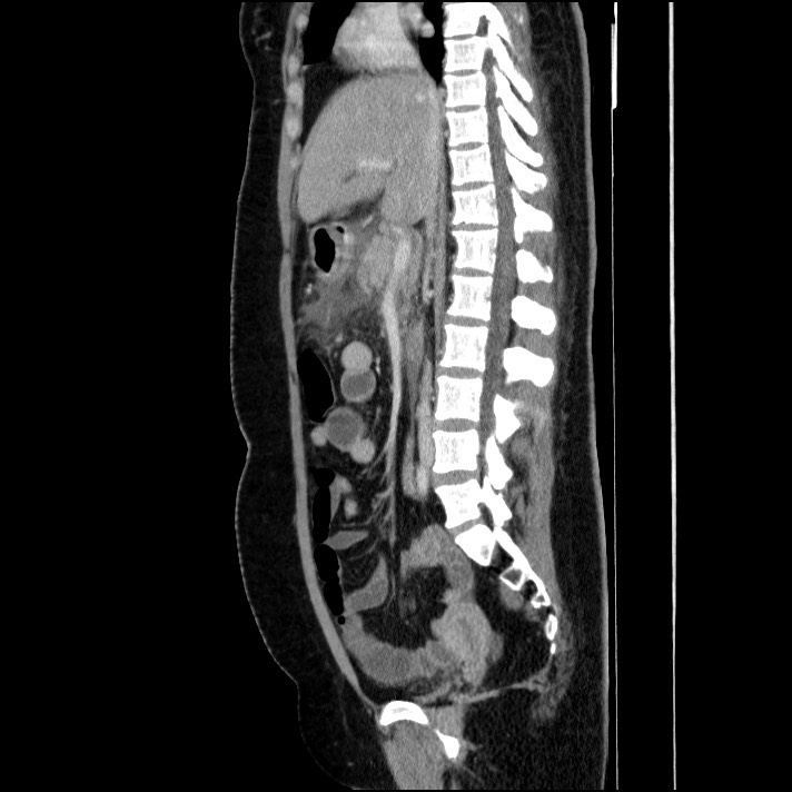 Acute pancreatitis (Radiopaedia 69236-79012 Sagittal C+ portal venous phase 56).jpg