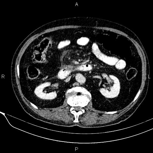 Acute pancreatitis (Radiopaedia 85146-100701 Axial C+ portal venous phase 31).jpg