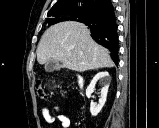 Acute pancreatitis (Radiopaedia 85146-100701 Sagittal C+ portal venous phase 24).jpg