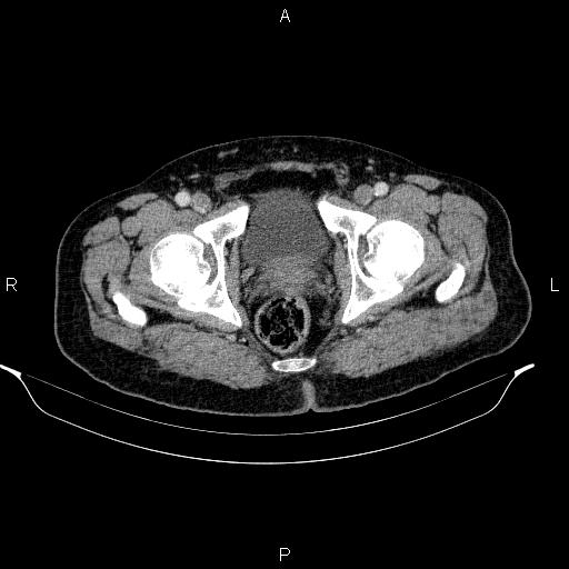 File:Acute pancreatitis (Radiopaedia 85390-101010 Axial C+ portal venous phase 106).jpg