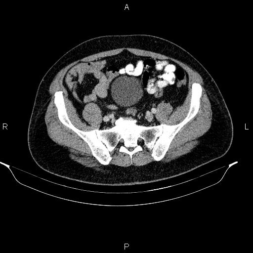 Acute pancreatitis (Radiopaedia 85390-101010 Axial C+ portal venous phase 83).jpg