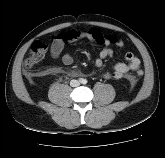 Acute pancreatitis - Balthazar E (Radiopaedia 23080-23110 Axial C+ portal venous phase 42).jpg
