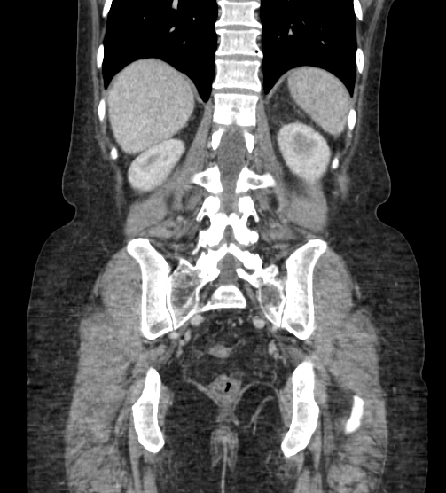 File:Acute pancreatitis - Balthazar E - post ERCP (Radiopaedia 27562-27772 Coronal C+ portal venous phase 67).png