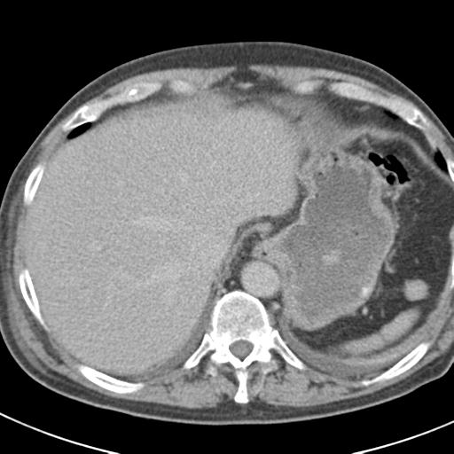 Acute pancreatitis and walled-off necrosis (Radiopaedia 29888-30403 Axial C+ delayed 16).jpg
