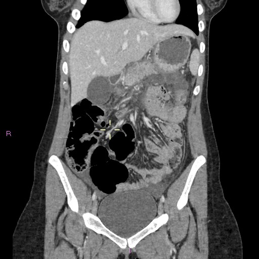 File:Acute pancreatitis secondary to stone at minor papilla and pancreatic divisum (Radiopaedia 76570-88333 Coronal C+ portal venous phase 7).jpg