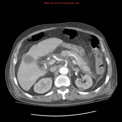 Acute pancreatitis with incidental pancreatic lipoma (Radiopaedia 10190-10730 Axial C+ arterial phase 34).jpg