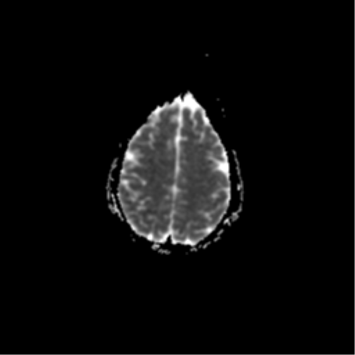 File:Acute pontine infarct from vertebral artery dissection (Radiopaedia 34111-35370 Axial ADC 18).png