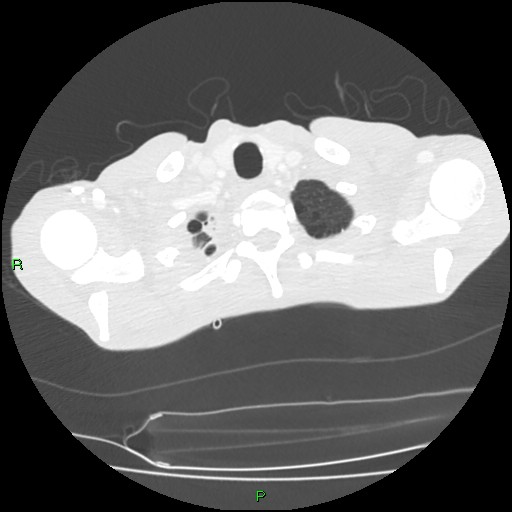 File:Acute right lung abscess (Radiopaedia 34806-36258 Axial lung window 9).jpg