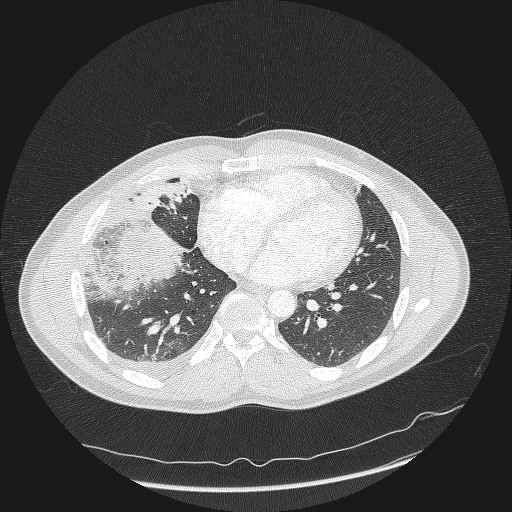 Acute segmental pulmonary emboli and pulmonary infarction (Radiopaedia 62264-70444 Axial lung window 125).jpg