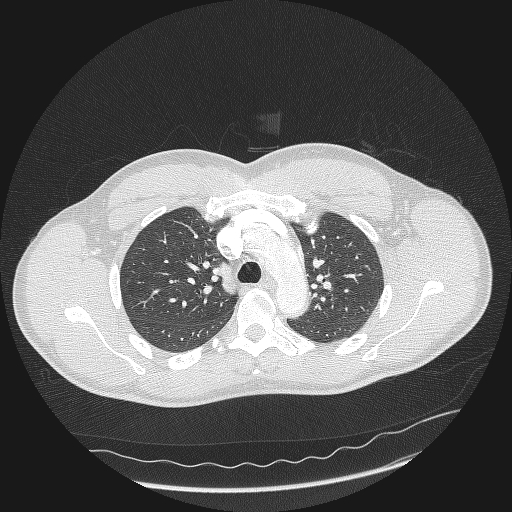 Acute segmental pulmonary emboli and pulmonary infarction (Radiopaedia 62264-70444 Axial lung window 51).jpg
