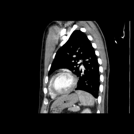 File:Acute segmental pulmonary emboli and pulmonary infarction (Radiopaedia 62264-70444 Sagittal C+ CTPA 48).jpg