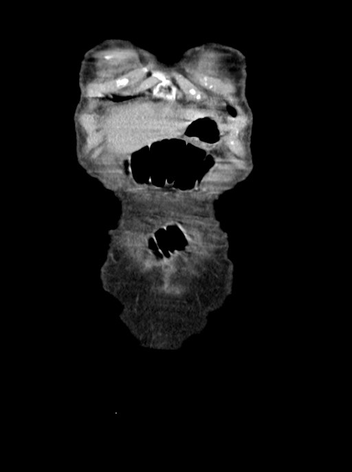 Acute small bowel (ileal) volvulus (Radiopaedia 71740-82139 Coronal C+ portal venous phase 10).jpg