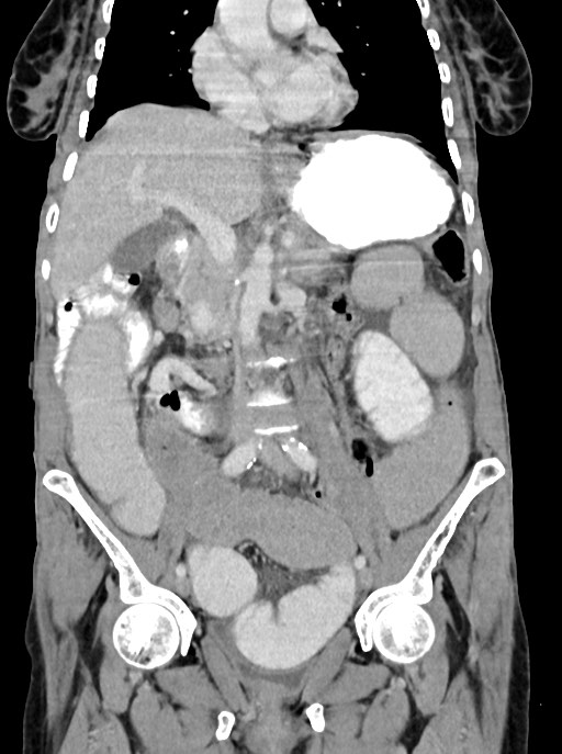 Acute small bowel (ileal) volvulus (Radiopaedia 71740-82139 Coronal C+ portal venous phase 54).jpg