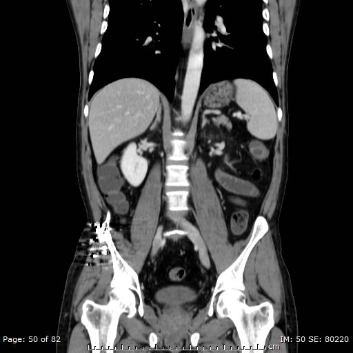 Acute superior mesenteric artery occlusion (Radiopaedia 43636-47060 Coronal C+ portal venous phase 35).jpg