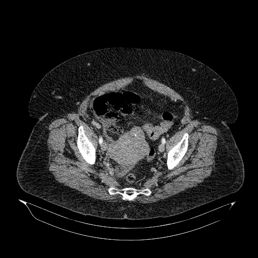 File:Acute superior mesenteric artery occlusion (Radiopaedia 51288-56960 Axial C+ arterial phase 80).jpg