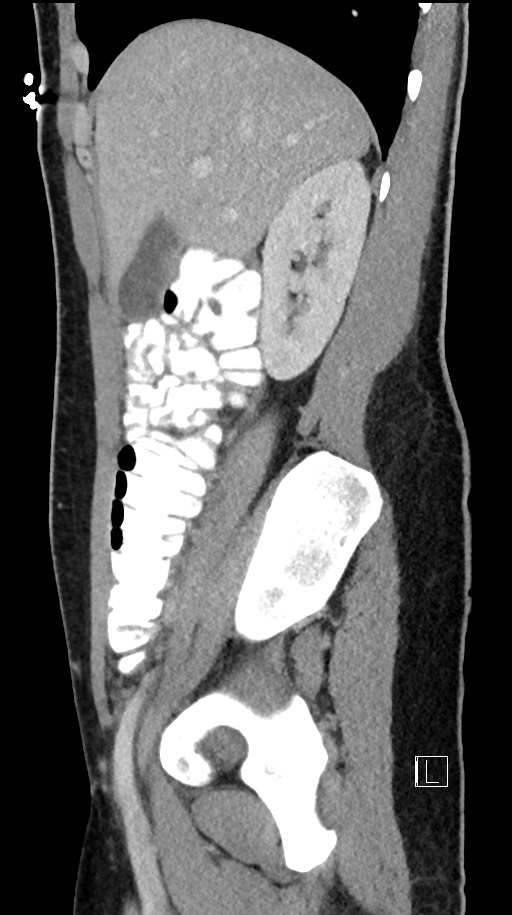 Acute uncomplicated appendicitis (Radiopaedia 61374-69304 Sagittal C+ portal venous phase 73).jpg