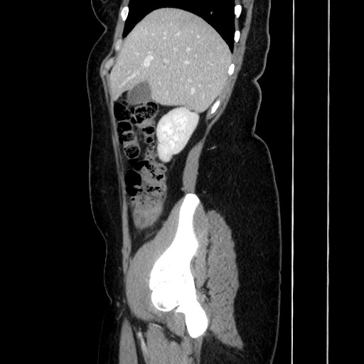 Acute uncomplicated appendicitis (Radiopaedia 73704-84499 Sagittal C+ portal venous phase 72).jpg