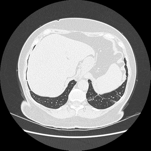 Adenocarcinoma in situ of lung (Radiopaedia 38685-40829 B 195).png