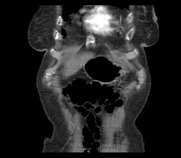 Adenocarcinoma of cecum (Radiopaedia 59222-66549 Coronal C+ arterial phase 8).jpg