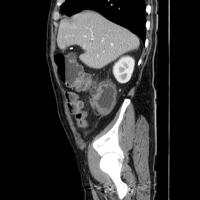 Adenocarcinoma of colon with entero-colic fistula (Radiopaedia 22832-22852 Sagittal C+ portal venous phase 15).jpg