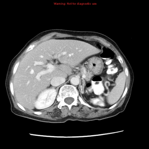 File:Adenocarcinoma of the colon (Radiopaedia 8191-9039 Axial liver window 20).jpg