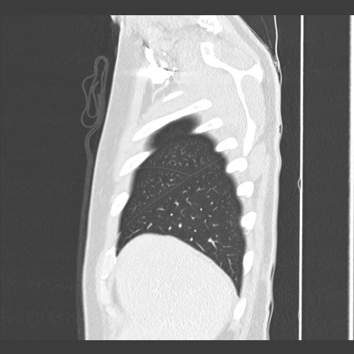 Adenocarcinoma of the lung (Radiopaedia 59871-67325 Sagittal lung window 10).jpg