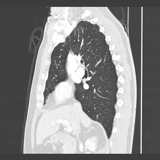 Adenocarcinoma of the lung (Radiopaedia 59871-67325 Sagittal lung window 39).jpg