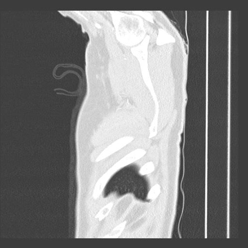 Adenocarcinoma of the lung (Radiopaedia 59871-67325 Sagittal lung window 99).jpg