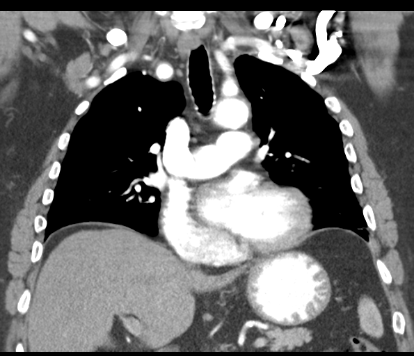 File:Adenocarcioma of rectum- T1 lesion (Radiopaedia 36921-38547 Coronal C+ arterial phase 31).png