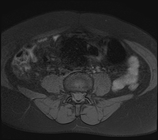 File:Adenomyosis - ovarian endometriomas (Radiopaedia 67031-76350 Axial T1 fat sat 2).jpg