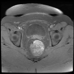 File:Adenomyosis within a didelphys uterus (Radiopaedia 70175-80215 Axial T1 fat sat 30).jpg