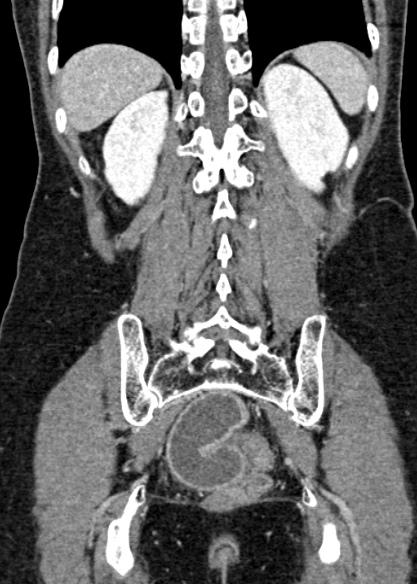 Adhesional small bowel obstruction (Radiopaedia 48397-53305 Coronal C+ portal venous phase 275).jpg